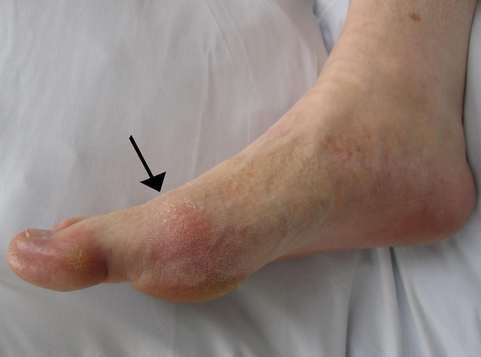 Acute gout of the first metatarsophalangeal joint of the big toe, with overlying redness marked by an arrow