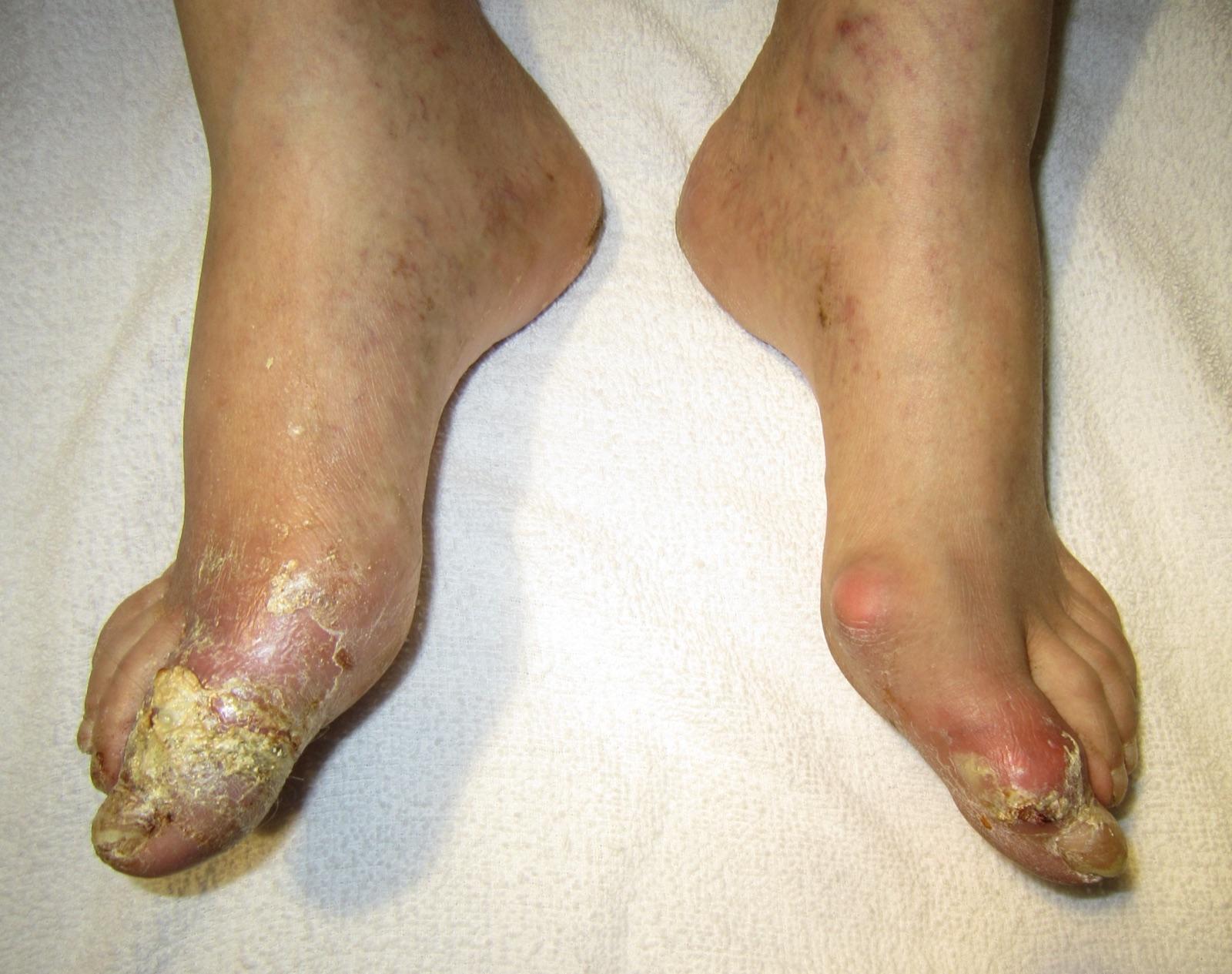 Severe tophaceous gout of the foot, with chalky uric acid crystal exudate from tophi